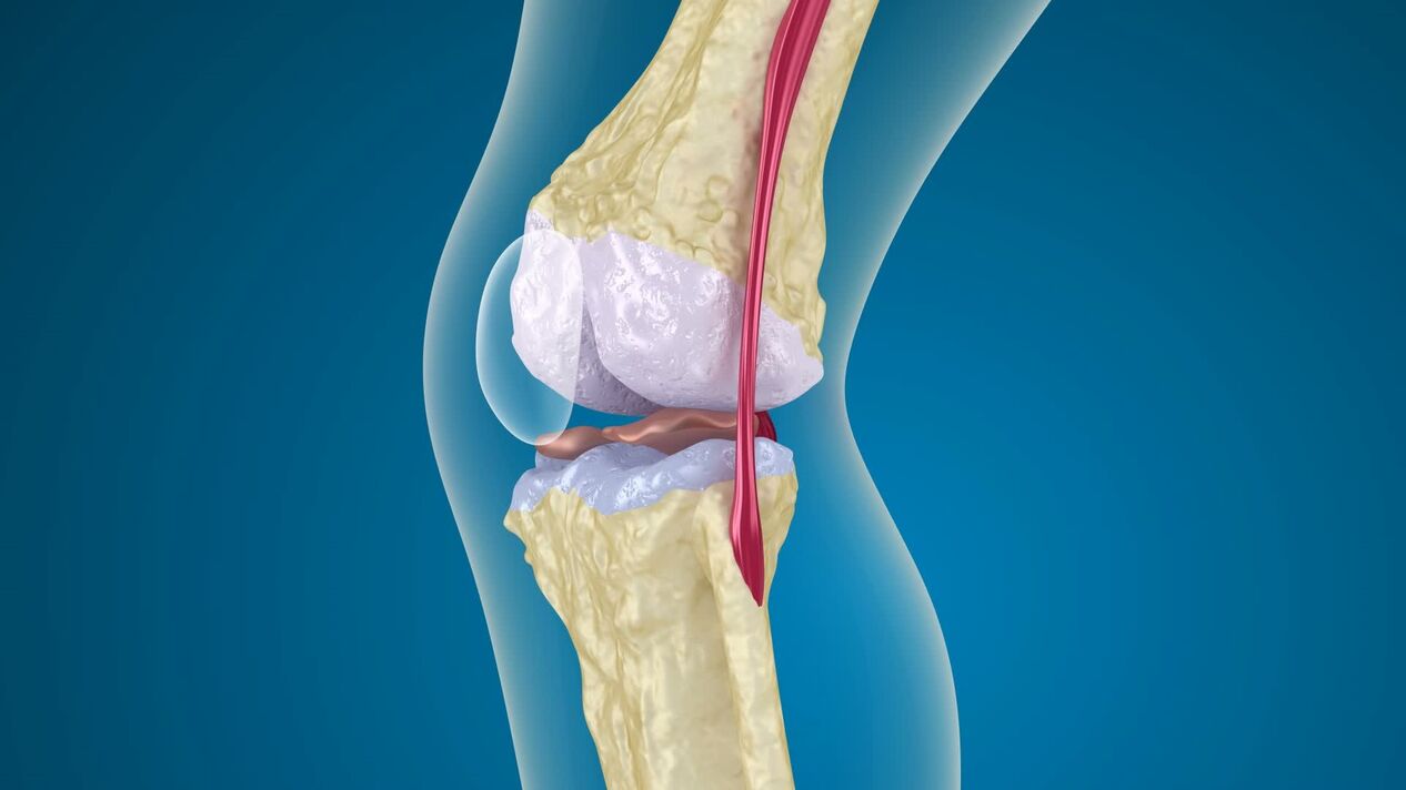 Distruzione dell'articolazione del ginocchio nell'osteoartrite