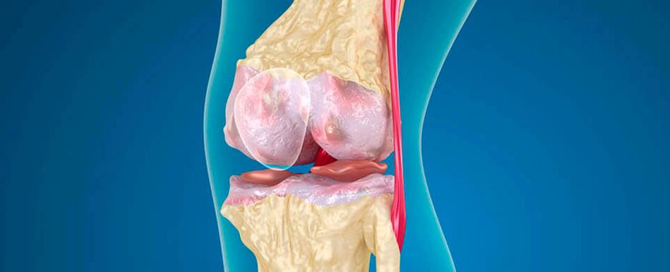 L'artrosi del ginocchio come causa del dolore