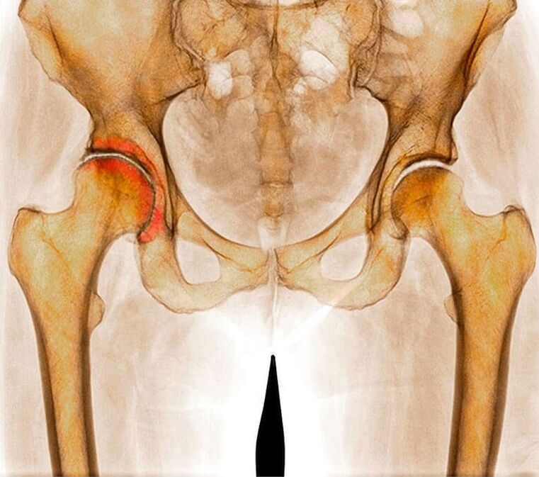 Infiammazione dell'articolazione dell'anca come causa del dolore