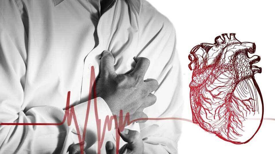 L'extrasistole può verificarsi a causa dell'aritmia cardiaca nell'osteocondrosi toracica