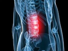 Osteocondrosi della colonna lombare