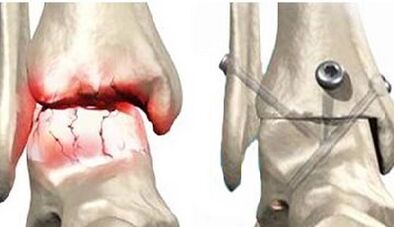 Trattamento chirurgico dell'osteoartrosi del ginocchio