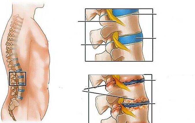 Osteocondrosi della regione lombare