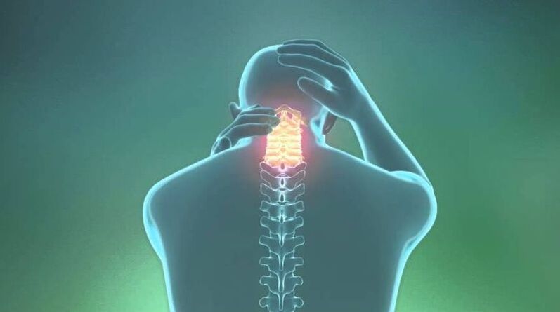 Osteocondrosi della regione di cervice
