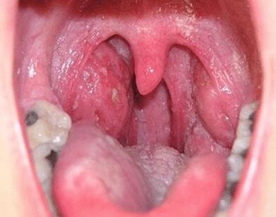 Quando hai mal di gola, ti fanno male il collo e il collo