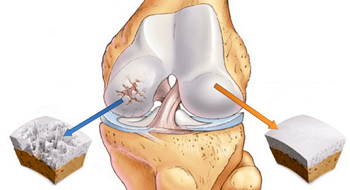 cartilagine sana affetta da osteoartrosi