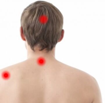 focolai di osteocondrosi