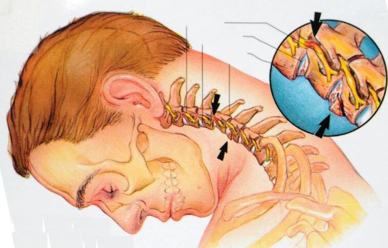 Cosa succede con l'osteocondrosi cervicale