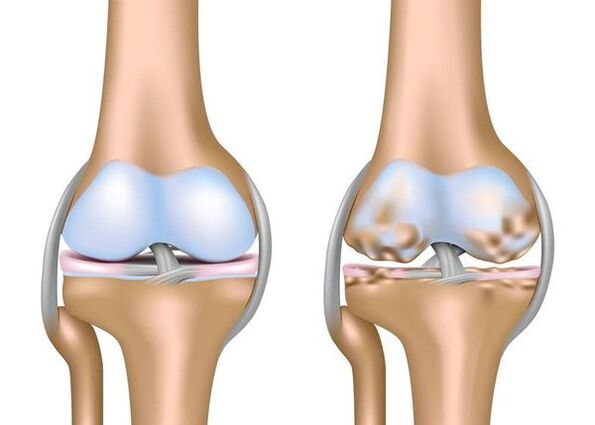 Osteoartrite