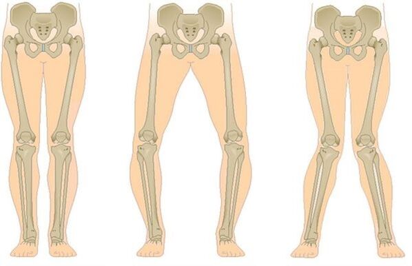 Tipi di osteoartrite