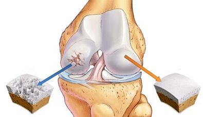 Le ragioni dello sviluppo dell'osteoartrite delle articolazioni