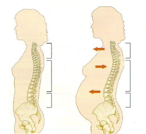 Osteocondrosi durante la gravidanza