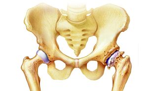 perché si verifica l'osteoartrosi dell'articolazione dell'anca